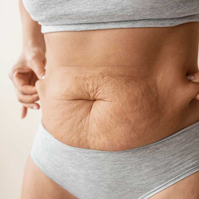cellulite-1